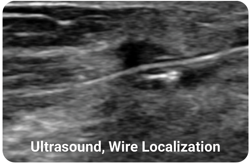 HydroMARK Plus wire localization under ultrasound